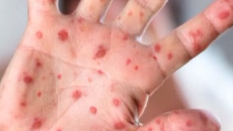 Amid a rise in measles cases across the country, the state Department of Health has issued an...